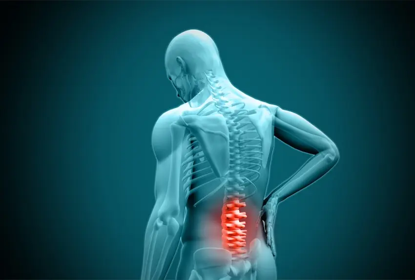 Medical diagram showing herniated disc and spinal soft tissue injury from car accident impact